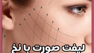 نخ های ترکیبی در لیفت صورت