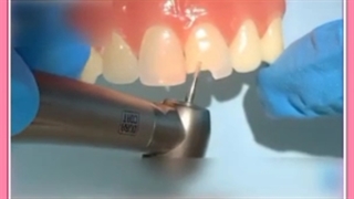 باندینگ دندان ها برای ترمیم دندان های آسیب دیده