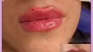 لیفت لب با ژل