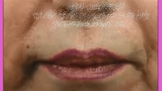 لیفت گوشه لب