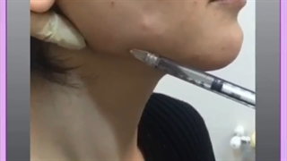 رایج ترین عمل های زیبایی صورت چیست؟