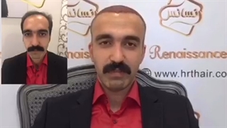 کاشت مو