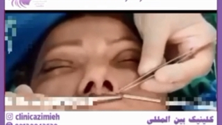 آیا مسواک زدن پس از لیفت لب اشکال دارد؟