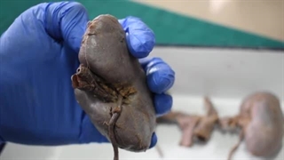 فیلم تشریح کلیه انسان- آناتومی کلیه انسان