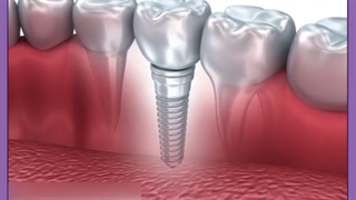 چه کسانی نمی توانند ایمپلنت کنند ؟