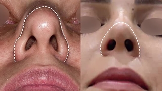 جراحی زیبایی بینی گوشتی و باکسی تیپ