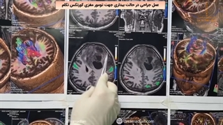 عمل جراحی در حالت بیداری جهت تومور مغزی کورتکس تکلم