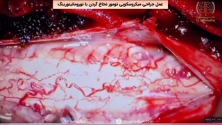 عمل جراحی میکروسکوپی تومور نخاع گردن با نورومانیتورینگ