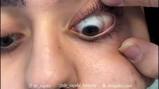 جراحی توده لیپودرموئید