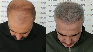 کاشت مو دو مرحله ای در کلینیک vip تهران