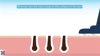 مقایسه انواع روشهای حذف موهای زائد