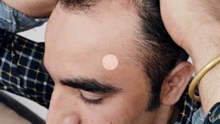 کاشت مو