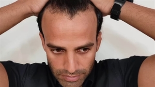 کاشت مو