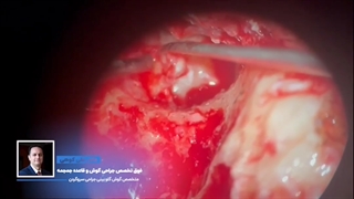 چگونگی عمل جراحی عصب فاسیال در کلستئاتوم