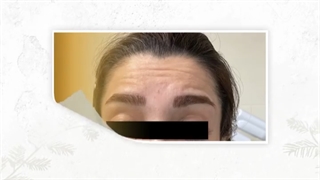 تزریق بوتاکس لیفت صورت