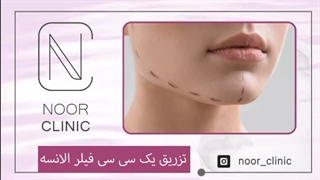 استفاده از فیلر الانسه