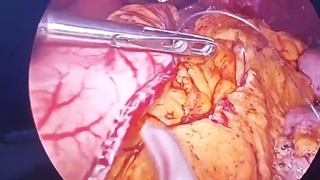 منگنه های روی معده در جراحی اسلیو