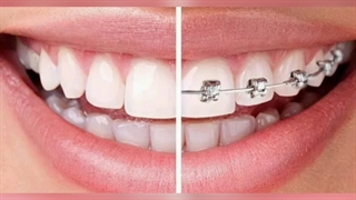 ارتودنسی دندان در کلینیک دندانپزشکی قلهک