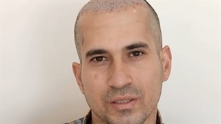 کاشت مو