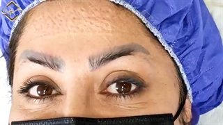 کاشت ابرو