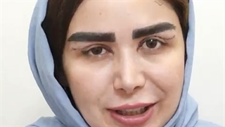 کاشت ابرو بلفارو پلاستی