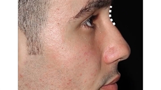 فیلم جراحی قوز بینی و انحراف بینی - دکتر کیان احمدی