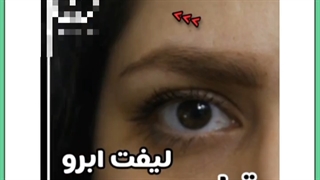 چه افرادی نیاز به لیفت ابرو دارند؟