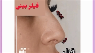 مزایای لیفت بینی چیست؟