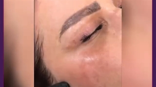 مقابله با لک های پوستی در فصل تابستان کاشت ریش