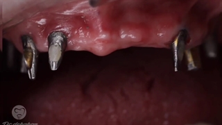 دکتر وحید دهقان : ایمپلنت فول فک بالا