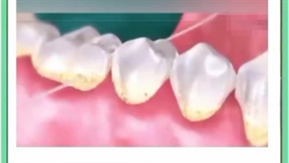 فرق جرم گیری معمولی با جرم گیری عمیق چیست؟