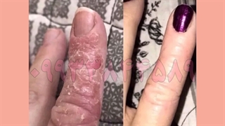 درمان پسوریازیس