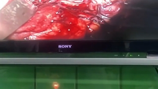 جراحی میکروسکوپی تومور مغزی