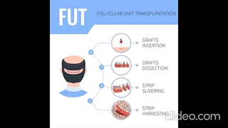 کاشت مو، به دو روش تهاجمی و کم تهاجمی