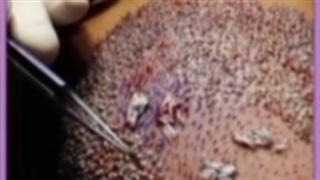 بهترین کلینیک های کاشت مو در شیراز