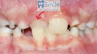 درمان کراس بایت