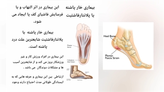 ورزش خارپاشنه و پا