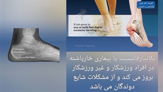 خارپاشنه و درمان خار پاشنه