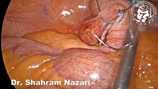 آپاندکتومی لاپاروسکوپیک درمان آپاندسیست