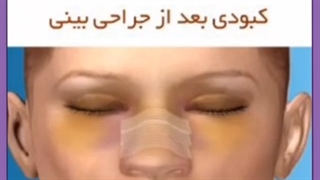 علت پف چشم