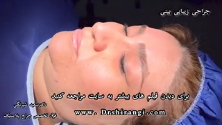 نتیجه جراحی بینی بلافاصله بعد از عمل
