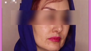 تزریق چربی با جدیدترین روش زیبایی