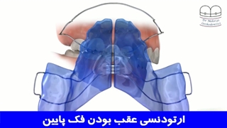 ارتودنسی عقب بودن فک پایین