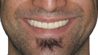 درمان جلو بودن فک با ارتودنسی و جراحی فک (عمل سارپه) | دکتر داودیان