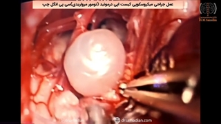 عمل جراحی میکروسکوپی کیست اپی درموئید (تومور مرواریدی)سی پی انگل چپ