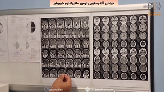 عمل جراحی آندوسکوپی تومور ماکروادنوم هیپوفیز