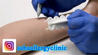 تست پوستی آلرژی و دارو