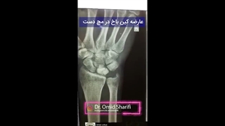 عارضه کین باخ درمج دست