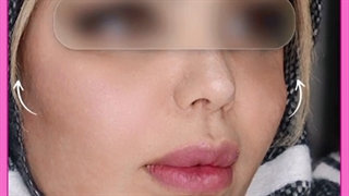 زیبا تر از همیشه با تزریق چربی