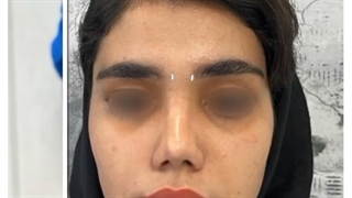جراحی بینی گوشتی-پس از 9 سال